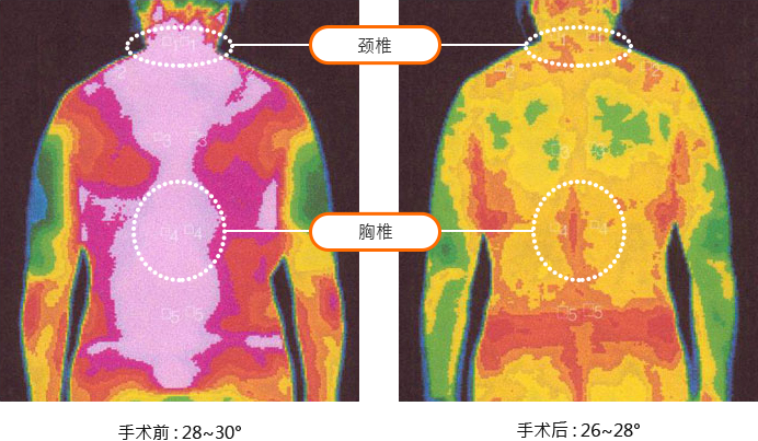 缩胸手术
