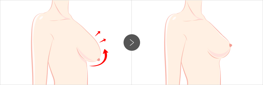 产后乳房下垂整形