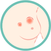 乳腺癌