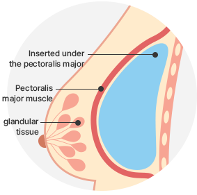 Breast Augmentation