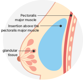 Breast Augmentation