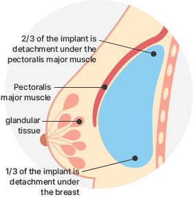 Breast Augmentation