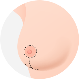 Breast Reduction