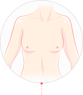 Post-Childbirth Breast Lift