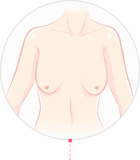Post-Childbirth Breast Lift