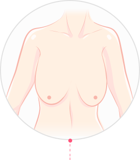 Post-Childbirth Breast Lift