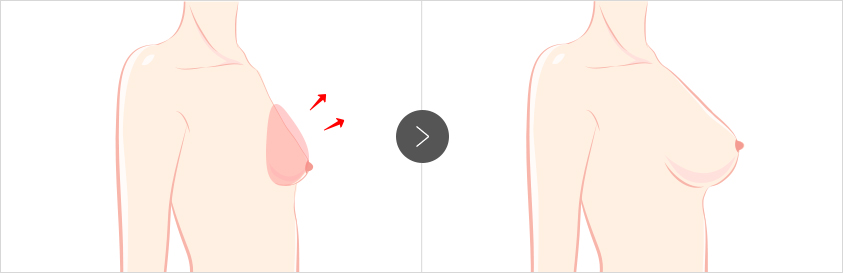 Post-Childbirth Breast Lift