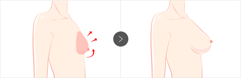 Post-Childbirth Breast Lift