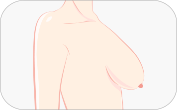 Correction of Sagging Breast