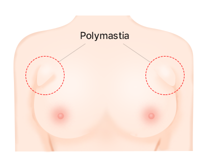 Accessory Breast Removal