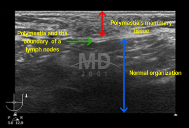 Accessory Breast Removal