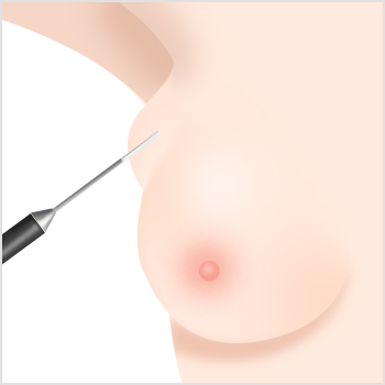 Accessory Breast Removal