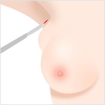 Accessory Breast Removal