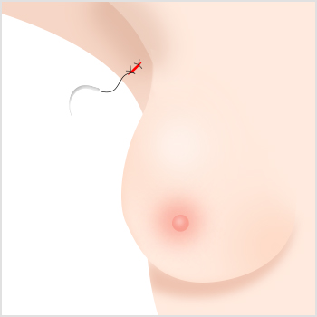 Accessory Breast Removal