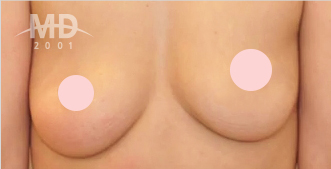 Breast Revision Surgery