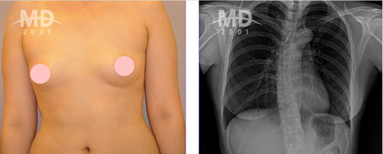 Breast Revision Surgery