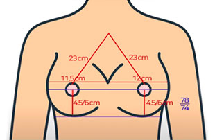 Breast Revision Surgery