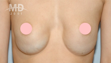 Breast Revision Surgery