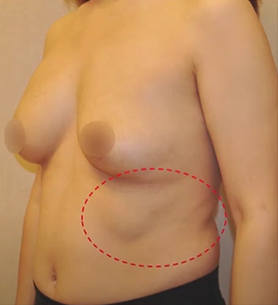 Breast Revision Surgery
