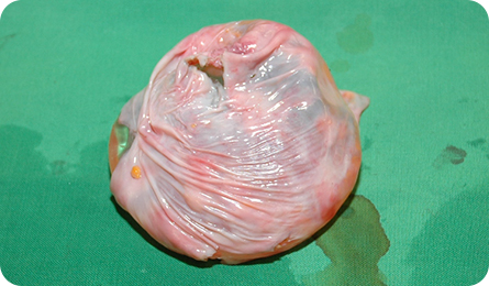 Breast Revision Surgery