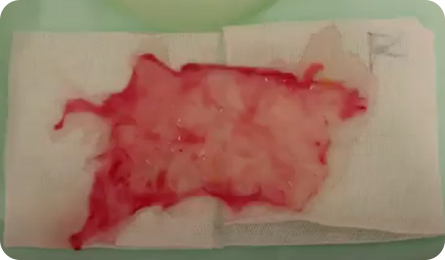 Breast Revision Surgery