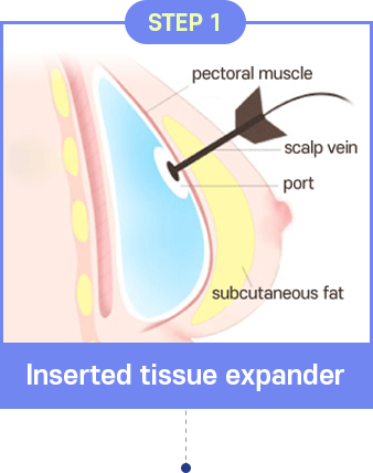 Breast Reconstruction