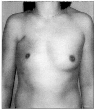 Poland Syndrome Correction