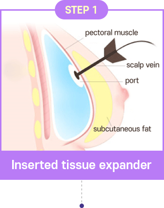 Poland Syndrome Correction