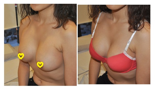 MD 수술후기