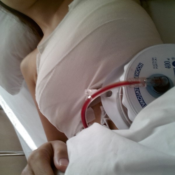 MD 수술후기