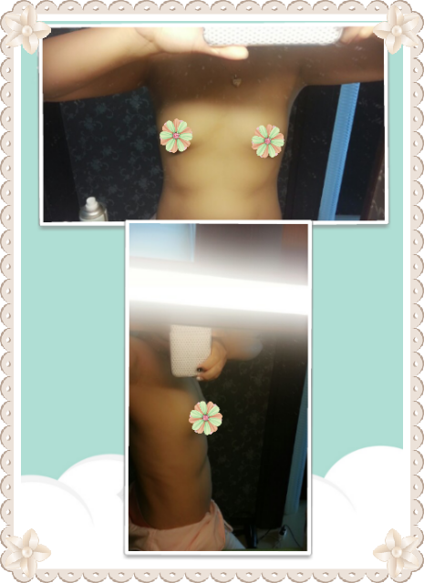 MD 수술후기