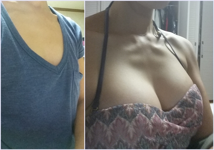 MD 수술후기