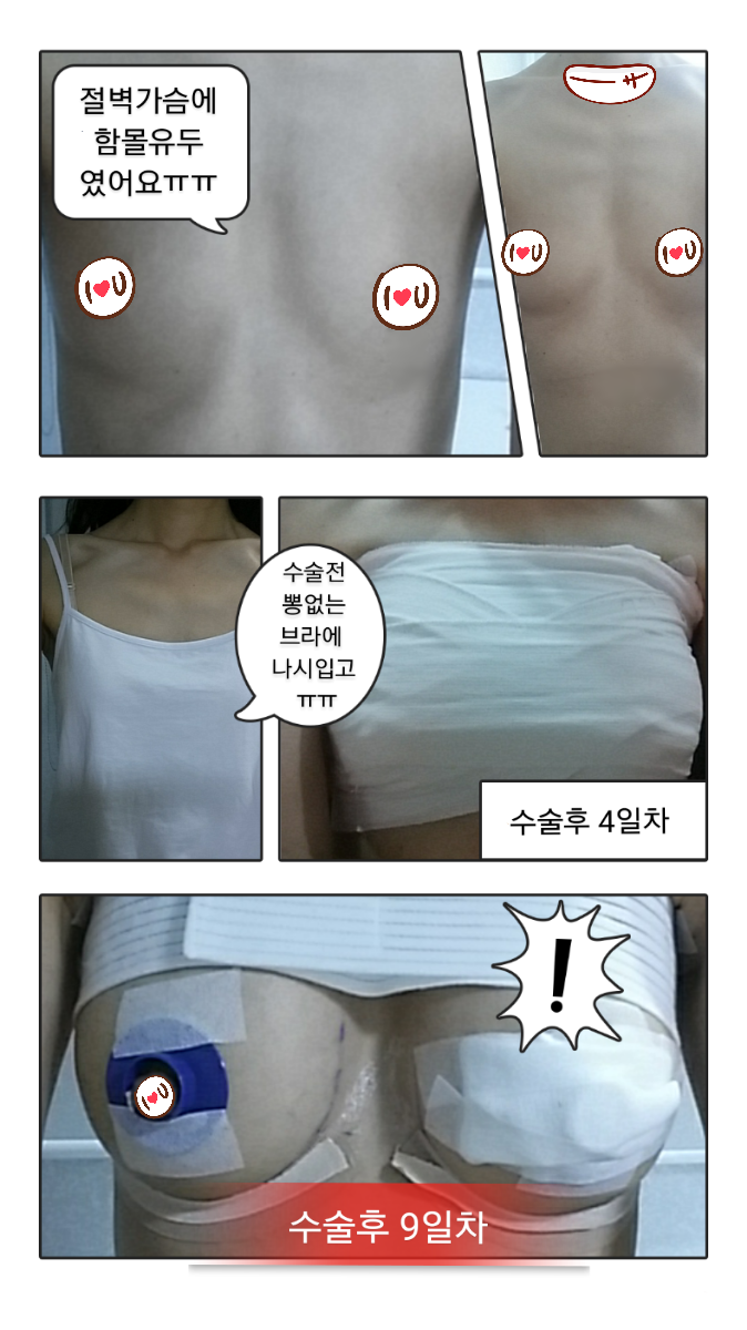 MD 수술후기