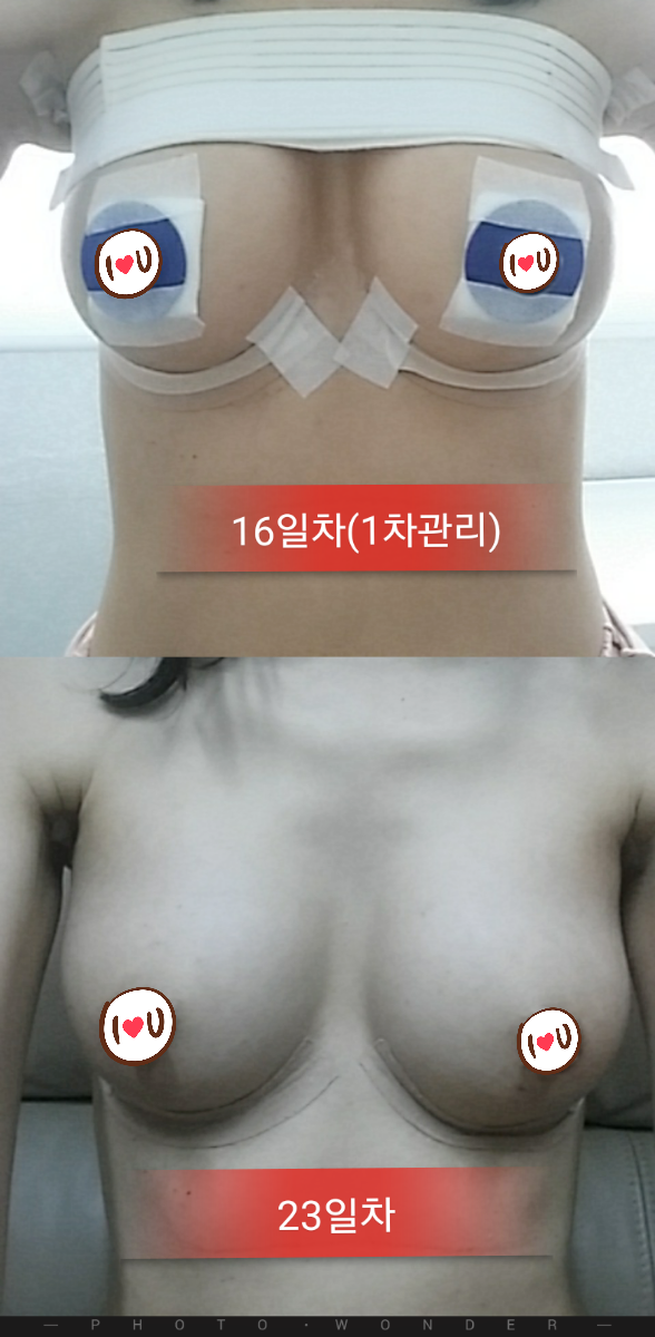 MD 수술후기