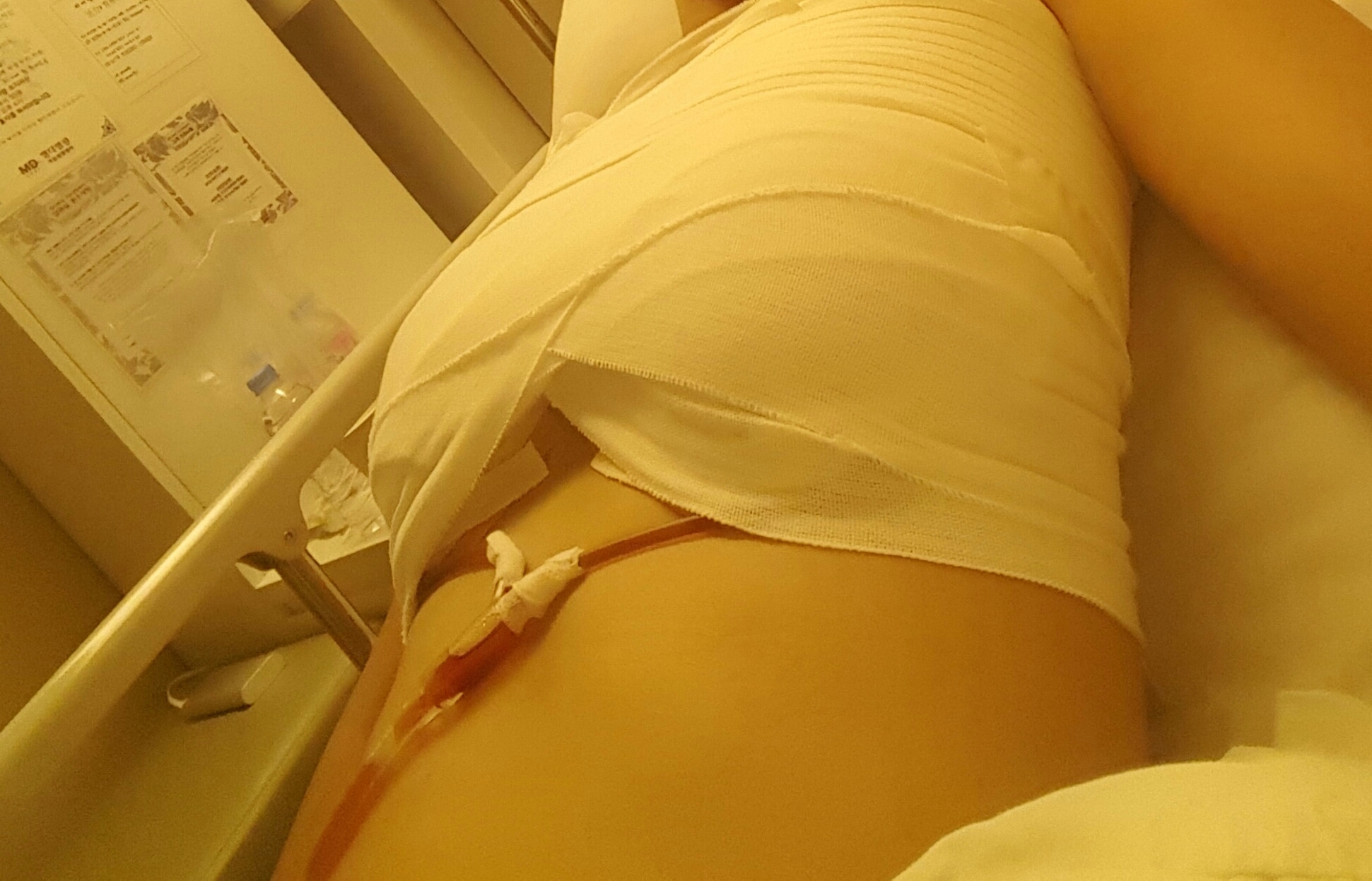 MD 수술후기