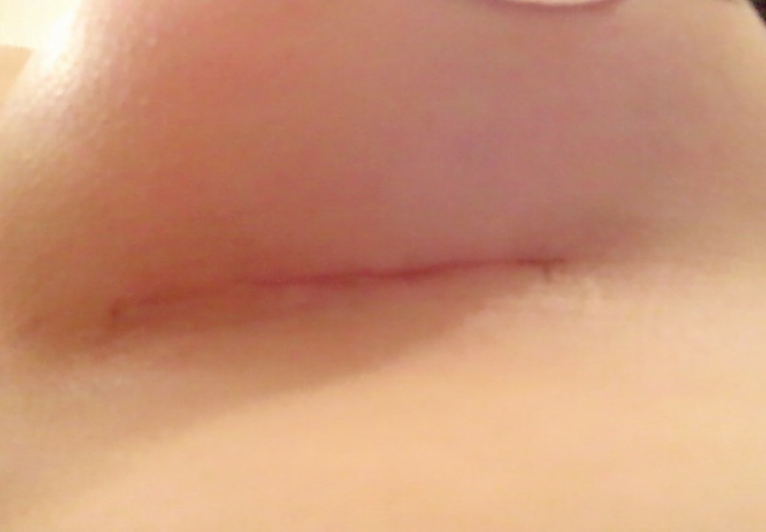 MD 수술후기