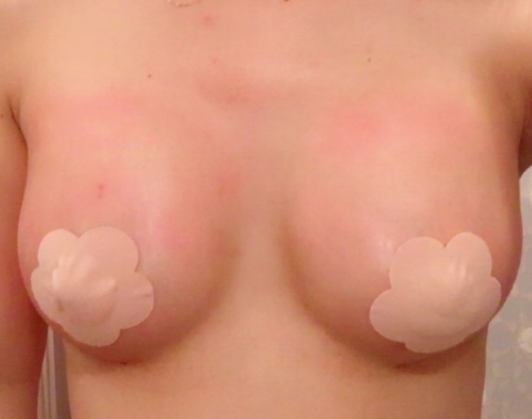 MD 수술후기