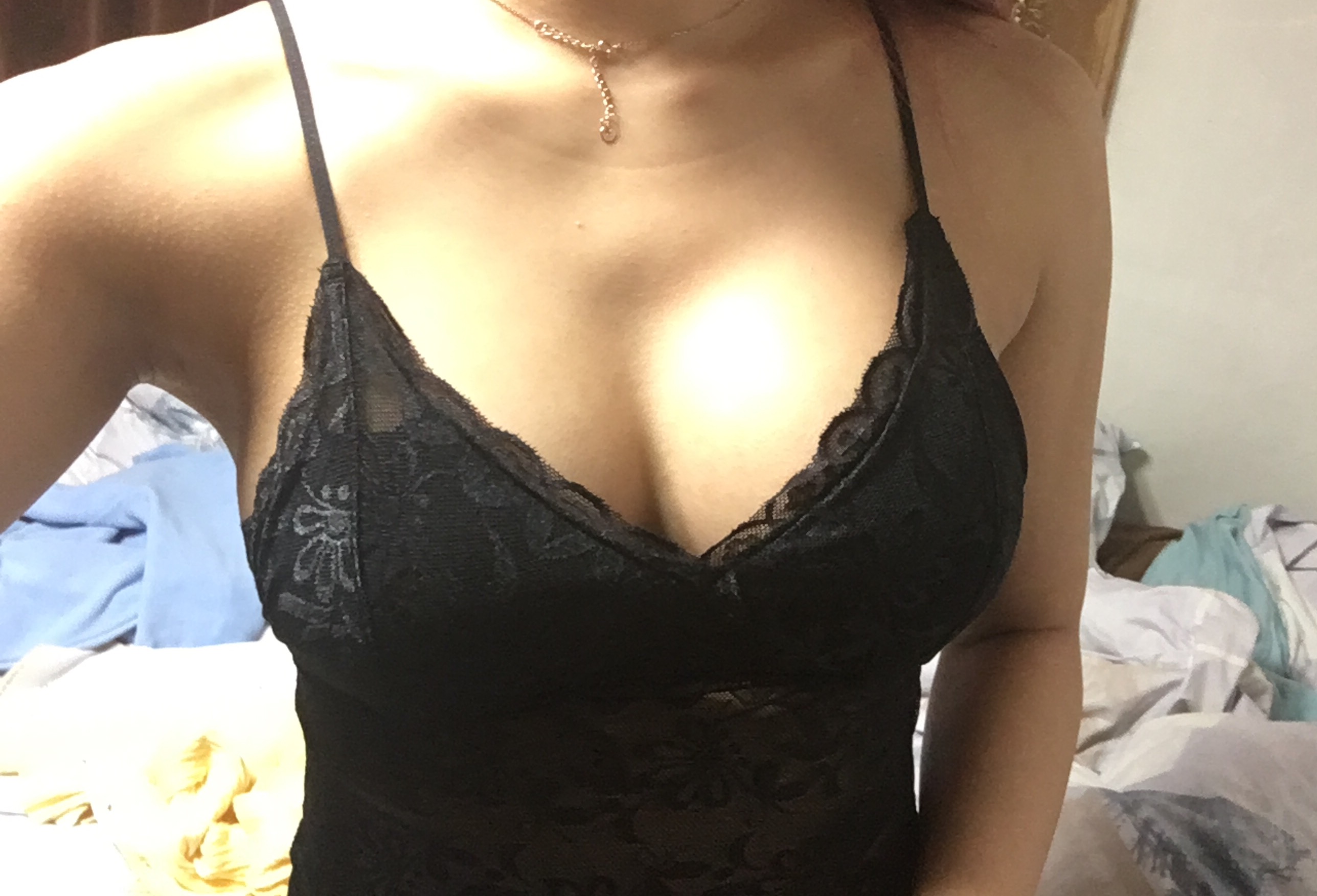 MD 수술후기