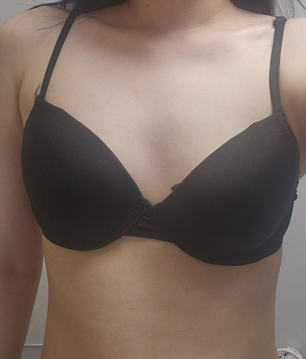 MD 수술후기